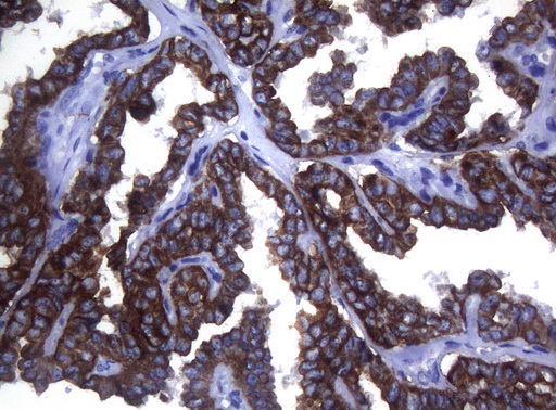 SYNC / SYNCOILIN Antibody - Immunohistochemical staining of paraffin-embedded Carcinoma of Human thyroid tissue using anti-SYNC mouse monoclonal antibody. (Heat-induced epitope retrieval by 1mM EDTA in 10mM Tris buffer. (pH8.5) at 120°C for 3 min. (1:150)