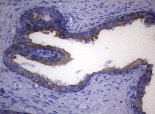 SYNC / SYNCOILIN Antibody - Immunohistochemical staining of paraffin-embedded Carcinoma of Human prostate tissue using anti-SYNC mouse monoclonal antibody. (Heat-induced epitope retrieval by 1mM EDTA in 10mM Tris buffer. (pH8.5) at 120°C for 3 min. (1:150)