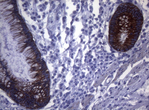 SYNC / SYNCOILIN Antibody - Immunohistochemical staining of paraffin-embedded Adenocarcinoma of Human colon tissue using anti-SYNC mouse monoclonal antibody. (Heat-induced epitope retrieval by 1mM EDTA in 10mM Tris buffer. (pH8.5) at 120°C for 3 min. (1:150)