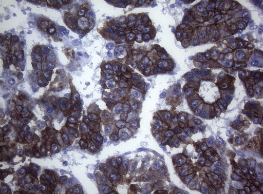 SYNC / SYNCOILIN Antibody - Immunohistochemical staining of paraffin-embedded Carcinoma of Human liver tissue using anti-SYNC mouse monoclonal antibody. (Heat-induced epitope retrieval by 1mM EDTA in 10mM Tris buffer. (pH8.5) at 120°C for 3 min. (1:150)