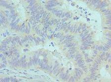 SYNCAM / CADM1 Antibody - Immunohistochemistry of paraffin-embedded human colon cancer using antibody at 1:100 dilution.