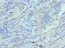 SYNCAM / CADM1 Antibody - Immunohistochemistry of paraffin-embedded human lung cancer using antibody at 1:100 dilution.