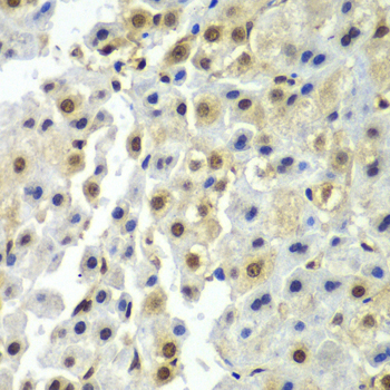 SYNCRIP / HnRNP Q Antibody - Immunohistochemistry of paraffin-embedded human liver cancer tissue.
