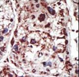 Syndapin I / PACSIN1 Antibody - Formalin-fixed and paraffin-embedded human cancer tissue reacted with the primary antibody, which was peroxidase-conjugated to the secondary antibody, followed by DAB staining. This data demonstrates the use of this antibody for immunohistochemistry; clinical relevance has not been evaluated. BC = breast carcinoma; HC = hepatocarcinoma.