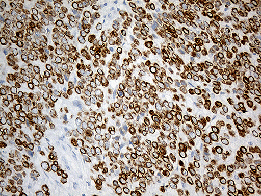 SYNE1 / Nesprin 1 Antibody - Immunohistochemical staining of paraffin-embedded Adenocarcinoma of Human breast tissue tissue using anti-SYNE1 mouse monoclonal antibody. (Heat-induced epitope retrieval by 1mM EDTA in 10mM Tris buffer. (pH8.5) at 120°C for 3 min. (1:500)