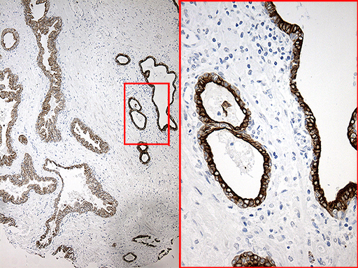 SYNE1 / Nesprin 1 Antibody - Immunohistochemical staining of paraffin-embedded Carcinoma of Human prostate tissue using anti-SYNE1 mouse monoclonal antibody. (Heat-induced epitope retrieval by 1mM EDTA in 10mM Tris buffer. (pH8.5) at 120°C for 3 min. (1:500)