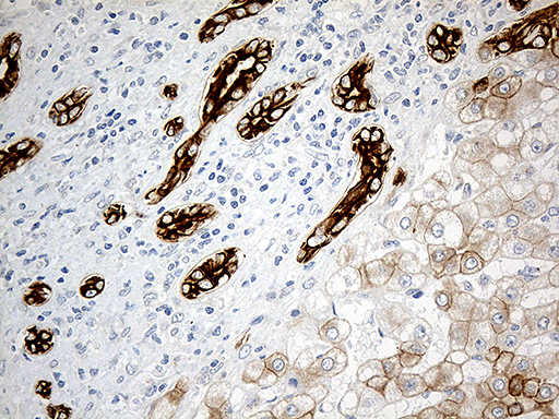 SYNE1 / Nesprin 1 Antibody - Immunohistochemical staining of paraffin-embedded Carcinoma of Human liver tissue using anti-SYNE1 mouse monoclonal antibody. (Heat-induced epitope retrieval by 1mM EDTA in 10mM Tris buffer. (pH8.5) at 120°C for 3 min. (1:500)