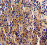 SYNE3 / C14orf49 Antibody - SYNE3 antibody immunohistochemistry of formalin-fixed and paraffin-embedded human Hodgkin lymphoma followed by peroxidase-conjugated secondary antibody and DAB staining.