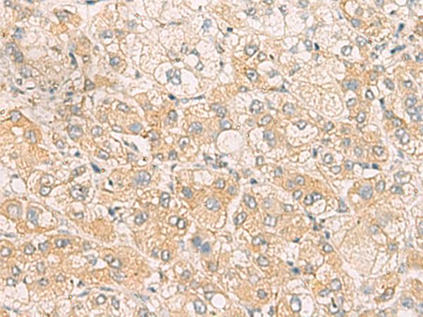 SYNGR1 / Synaptogyrin 1 Antibody - Immunohistochemistry of paraffin-embedded Human liver cancer tissue  using SYNGR1 Polyclonal Antibody at dilution of 1:60(×200)
