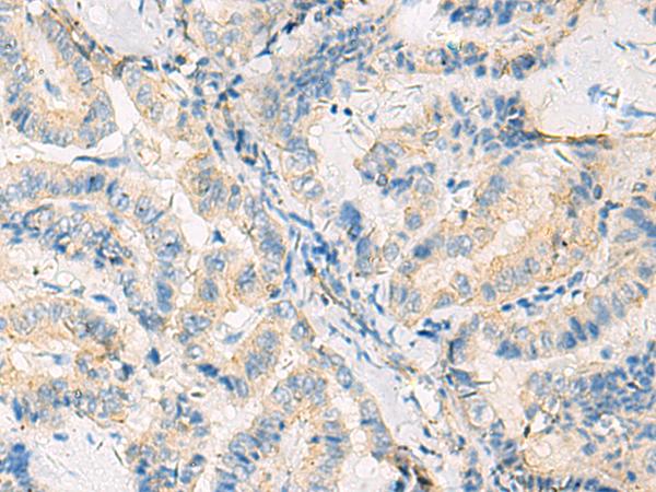 SYNGR1 / Synaptogyrin 1 Antibody - Immunohistochemistry of paraffin-embedded Human thyroid cancer tissue  using SYNGR1 Polyclonal Antibody at dilution of 1:50(×200)