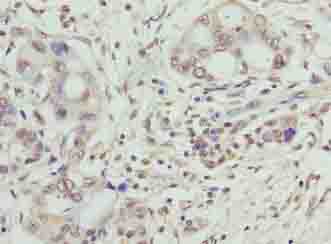 SYNJ2BP / OMP25 Antibody - Immunohistochemistry of paraffin-embedded human pancreatic cancer using antibody at dilution of 1:100.