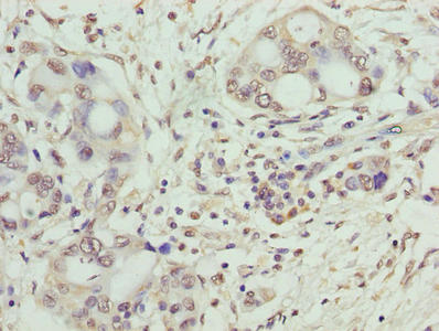 SYNJ2BP / OMP25 Antibody - Immunohistochemistry of paraffin-embedded human pancreatic cancer using SYNJ2BP Antibody at dilution of 1:100