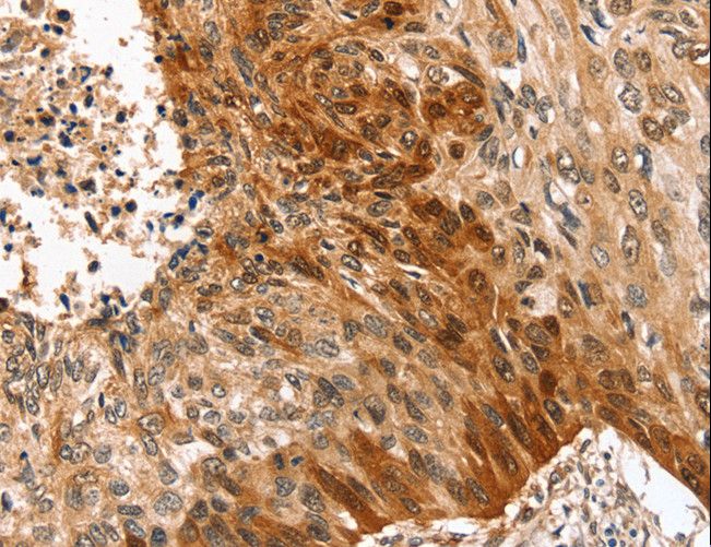 SYNPO2 / Synaptopodin 2 Antibody - Immunohistochemistry of paraffin-embedded Human esophagus cancer using SYNPO2 Polyclonal Antibody at dilution of 1:50.