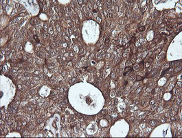SYP / Synaptophysin Antibody - IHC of paraffin-embedded Adenocarcinoma of Human breast tissue using anti-SYP mouse monoclonal antibody. (Heat-induced epitope retrieval by 10mM citric buffer, pH6.0, 120°C for 3min).