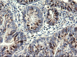 SYP / Synaptophysin Antibody - IHC of paraffin-embedded Carcinoma of Human pancreas tissue using anti-SYP mouse monoclonal antibody.