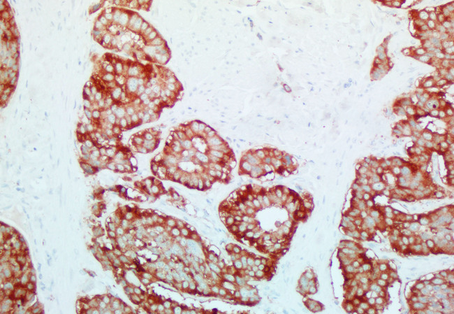 SYP / Synaptophysin Antibody - Immunohistochemical staining of paraffin-embedded human carcinoid tumor using anti-SYP clone UMAB112 mouse monoclonal antibody at 1:200 dilution of 0.4mg/mL and detection with Polink2 Broad HRP DAB.requires heat-induced epitope retrieval with Citrate pH6.0 at 95-100C 20 minutes. The image shows strong membranous and cytoplasmic staining in the tumor cells with surrounding stroma negative.