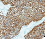 SYP / Synaptophysin Antibody - IHC of Synaptophysin on FFPE Neuroendocrine Tumor.