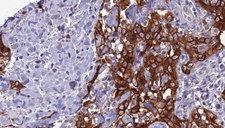 SYP / Synaptophysin Antibody - 1:100 staining human Head and neck carcinoma tissue by IHC-P. The sample was formaldehyde fixed and a heat mediated antigen retrieval step in citrate buffer was performed. The sample was then blocked and incubated with the antibody for 1.5 hours at 22°C. An HRP conjugated goat anti-rabbit antibody was used as the secondary.