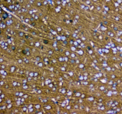 SYT1 / Synaptotagmin Antibody - IHC testing of FFPE human glioma with SYT1 antibody at 1ug/ml. Required HIER: steam section in pH6 citrate buffer for 20 min and allow to cool prior to staining.