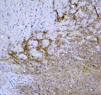 SYT1 / Synaptotagmin Antibody - IHC testing of FFPE human melanoma with SYT1 antibody at 1ug/ml. Required HIER: steam section in pH6 citrate buffer for 20 min and allow to cool prior to staining.
