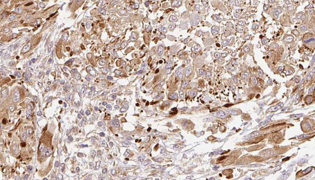 SYT1 / Synaptotagmin Antibody - 1:100 staining human Melanoma tissue by IHC-P. The sample was formaldehyde fixed and a heat mediated antigen retrieval step in citrate buffer was performed. The sample was then blocked and incubated with the antibody for 1.5 hours at 22°C. An HRP conjugated goat anti-rabbit antibody was used as the secondary.