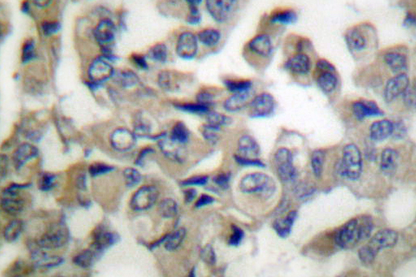SYT1 / Synaptotagmin Antibody - IHC of Synaptotagmin (M303) pAb in paraffin-embedded human breast carcinoma tissue.
