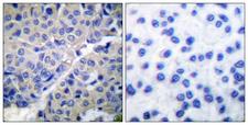 SYT1 / Synaptotagmin Antibody - Immunohistochemistry analysis of paraffin-embedded human breast carcinoma, using Synaptotagmin (Phospho-Ser309) Antibody. The picture on the right is blocked with the phospho peptide.