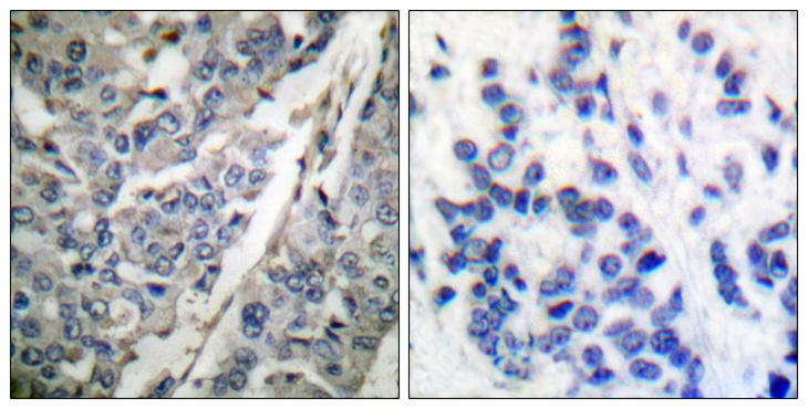 SYT1 / Synaptotagmin Antibody - Immunohistochemistry analysis of paraffin-embedded human breast carcinoma, using Synaptotagmin (Phospho-Thr202) Antibody. The picture on the right is blocked with the phospho peptide.