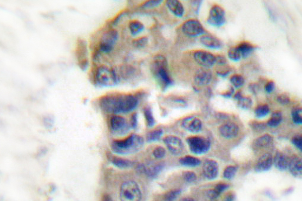 SYT1 / Synaptotagmin Antibody - IHC of Synaptotagmin (T196) pAb in paraffin-embedded human breast carcinoma tissue.