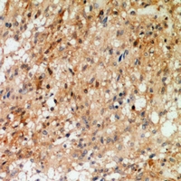 SYT1 + SYT2 Antibody - Immunohistochemical analysis of Synaptotagmin (pT202/199) staining in human breast cancer formalin fixed paraffin embedded tissue section. The section was pre-treated using heat mediated antigen retrieval with sodium citrate buffer (pH 6.0). The section was then incubated with the antibody at room temperature and detected using an HRP conjugated compact polymer system. DAB was used as the chromogen. The section was then counterstained with haematoxylin and mounted with DPX.