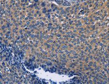 SYT17 Antibody - Immunohistochemistry of paraffin-embedded Human cervical cancer using SYT17 Polyclonal Antibody at dilution of 1:60.