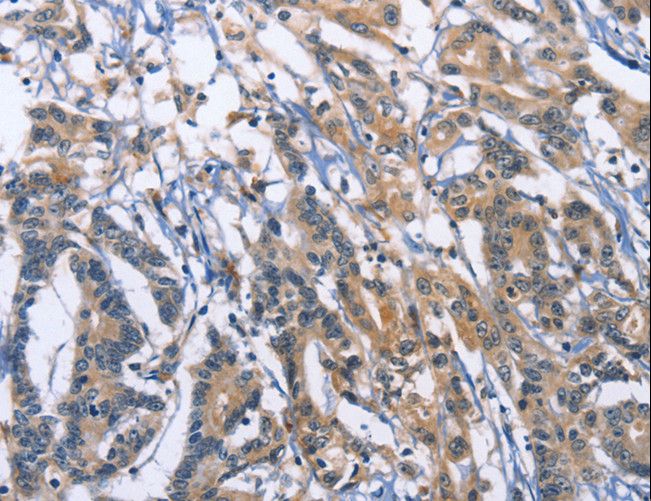 SYT17 Antibody - Immunohistochemistry of paraffin-embedded Human colon cancer using SYT17 Polyclonal Antibody at dilution of 1:60.