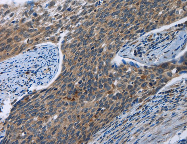 SYT3 / Synaptotagmin 3 Antibody - Immunohistochemistry of paraffin-embedded Human cervical cancer using SYT3 Polyclonal Antibody at dilution of 1:40.
