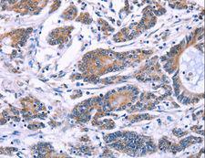SYT4 Antibody - Immunohistochemistry of paraffin-embedded Human colon cancer using SYT4 Polyclonal Antibody at dilution of 1:60.