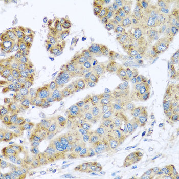 SYT4 Antibody - Immunohistochemistry of paraffin-embedded human liver cancer using SYT4 antibody at dilution of 1:100 (x40 lens).