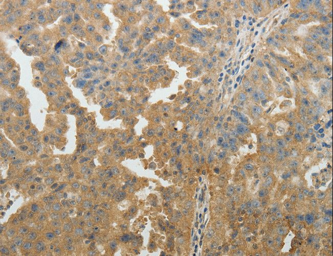 SYT6 / Synaptotagmin 6 Antibody - Immunohistochemistry of paraffin-embedded Human lung cancer using SYT6 Polyclonal Antibody at dilution of 1:40.