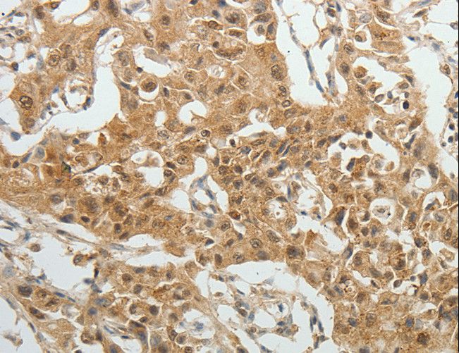 SYT6 / Synaptotagmin 6 Antibody - Immunohistochemistry of paraffin-embedded Human lung cancer using SYT6 Polyclonal Antibody at dilution of 1:40.