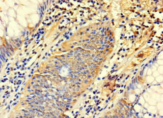SYTL3 Antibody - Immunohistochemistry of paraffin-embedded human colon cancer using SYTL3 Antibody at dilution of 1:100