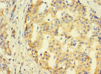 SYTL3 Antibody - Immunohistochemistry of paraffin-embedded human pancreatic cancer using SYTL3 Antibody at dilution of 1:100