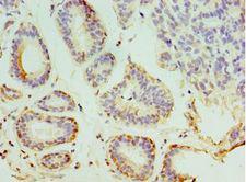 SYTL4 / Granuphilin Antibody - Immunohistochemistry of paraffin-embedded human breast cancer using antibody at 1:100 dilution.