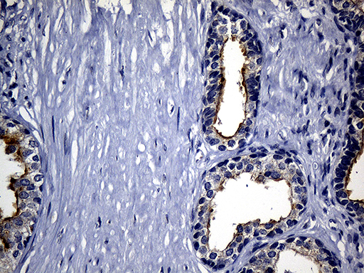 SYTL4 / Granuphilin Antibody - Immunohistochemical staining of paraffin-embedded Carcinoma of Human prostate tissue using anti-SYTL4 mouse monoclonal antibody. (Heat-induced epitope retrieval by 1mM EDTA in 10mM Tris buffer. (pH8.5) at 120°C for 3 min. (1:500)