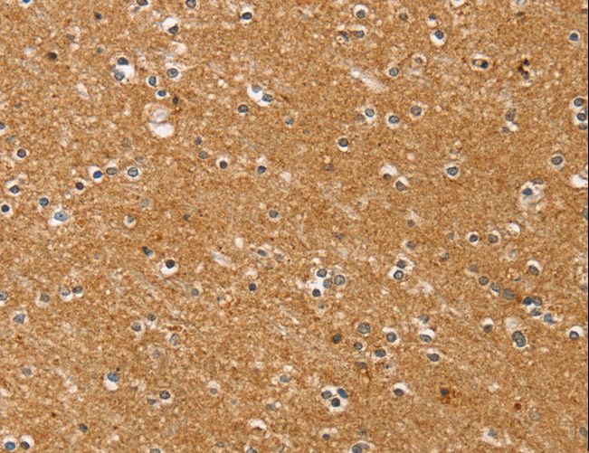 SYTL5 Antibody - Immunohistochemistry of paraffin-embedded Human esophagus cancer using SYTL5 Polyclonal Antibody at dilution of 1:50.