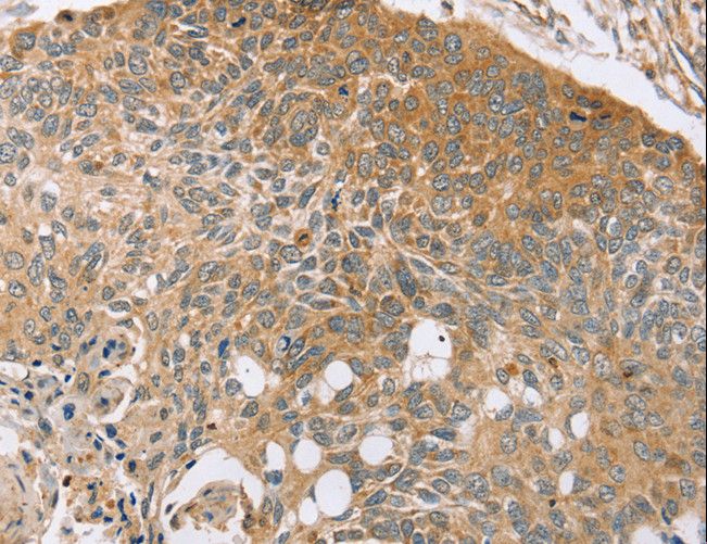 SYTL5 Antibody - Immunohistochemistry of paraffin-embedded Human esophagus cancer using SYTL5 Polyclonal Antibody at dilution of 1:50.
