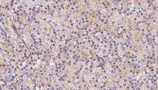 SYVN1 / HRD1 Antibody - 1:100 staining human lymph carcinoma tissue by IHC-P. The sample was formaldehyde fixed and a heat mediated antigen retrieval step in citrate buffer was performed. The sample was then blocked and incubated with the antibody for 1.5 hours at 22°C. An HRP conjugated goat anti-rabbit antibody was used as the secondary.