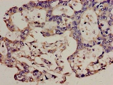 T-cell receptor beta-chain V region, clone WBDM28A Antibody - Immunohistochemistry analysis of human pancreatic cancer at a dilution of 1:100