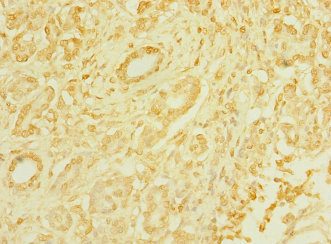 T1R3 / TAS1R3 Antibody - Immunohistochemistry of paraffin-embedded human pancreatic cancer at dilution 1:100