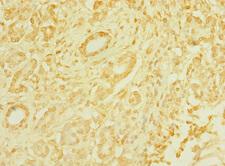 T1R3 / TAS1R3 Antibody - Immunohistochemistry of paraffin-embedded human pancreatic cancer at dilution 1:100