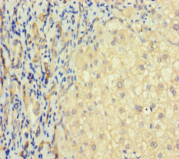 T2R41 / TAS2R41 Antibody - Immunohistochemistry of paraffin-embedded human liver cancer using TAS2R41 Antibody at dilution of 1:100