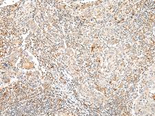 TAAR2 / GPR58 Antibody - Immunohistochemistry of paraffin-embedded Human cervical cancer tissue  using TAAR2 Polyclonal Antibody at dilution of 1:40(×200)