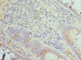 TAB1 Antibody - Immunohistochemistry of paraffin-embedded human colon cancer using antibody 1:100 dilution.